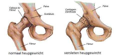 Coxartrose – artrose van de heup hulpmiddelen
