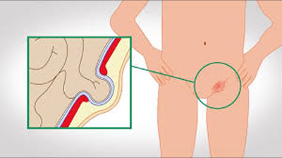 hernia inguinalis