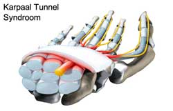 carpaal tunnel syndroom