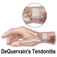 quervain tendonitis in beeld
