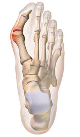 hallux valgus