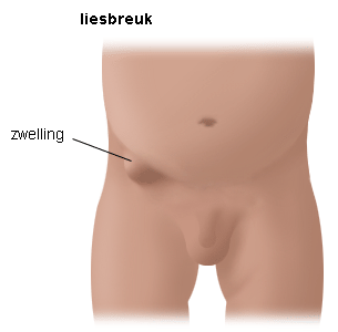 liesbreuk liesbreuk