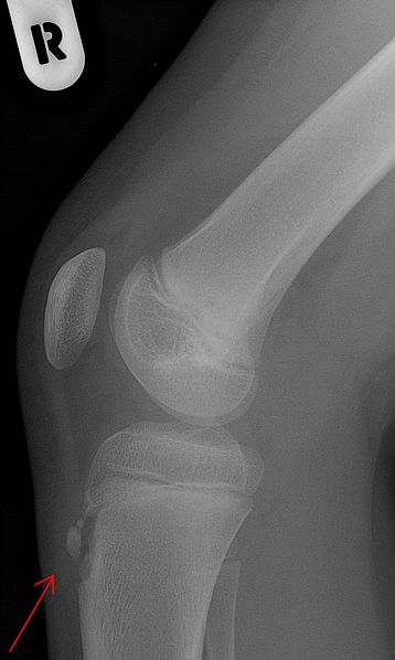röntgenfoto van een knie met Osgood Schlatter